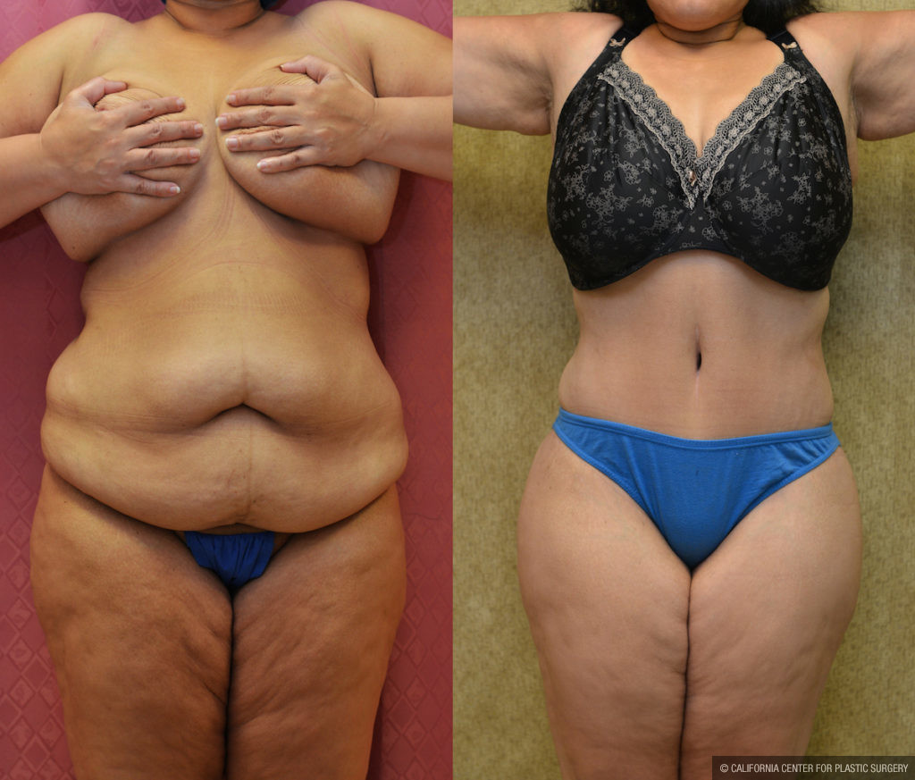 Tummy Tuck (Abdominoplasty) Plus Size Before & After Patient #11547