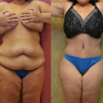 Tummy Tuck (Abdominoplasty) Plus Size Before & After Patient #11547