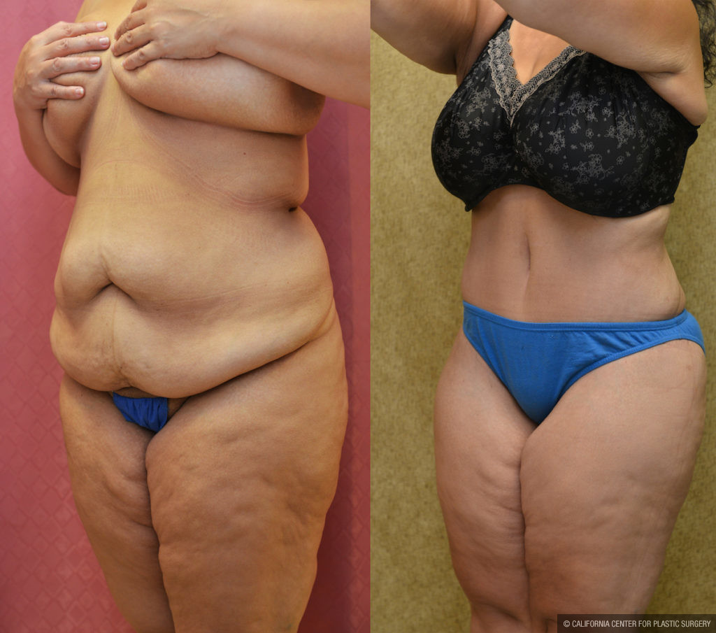 Tummy Tuck (Abdominoplasty) Plus Size Before & After Patient #11547