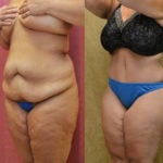 Tummy Tuck (Abdominoplasty) Plus Size Before & After Patient #11547