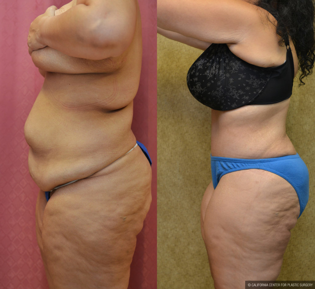 Tummy Tuck (Abdominoplasty) Plus Size Before & After Patient #11547