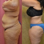 Tummy Tuck (Abdominoplasty) Plus Size Before & After Patient #11547