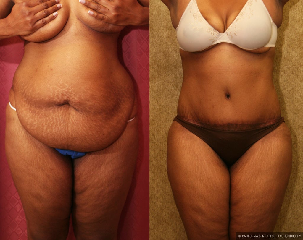 Tummy Tuck (Abdominoplasty) Plus Size Before & After Patient #11551