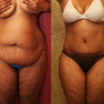 Tummy Tuck (Abdominoplasty) Plus Size Before & After Patient #11551