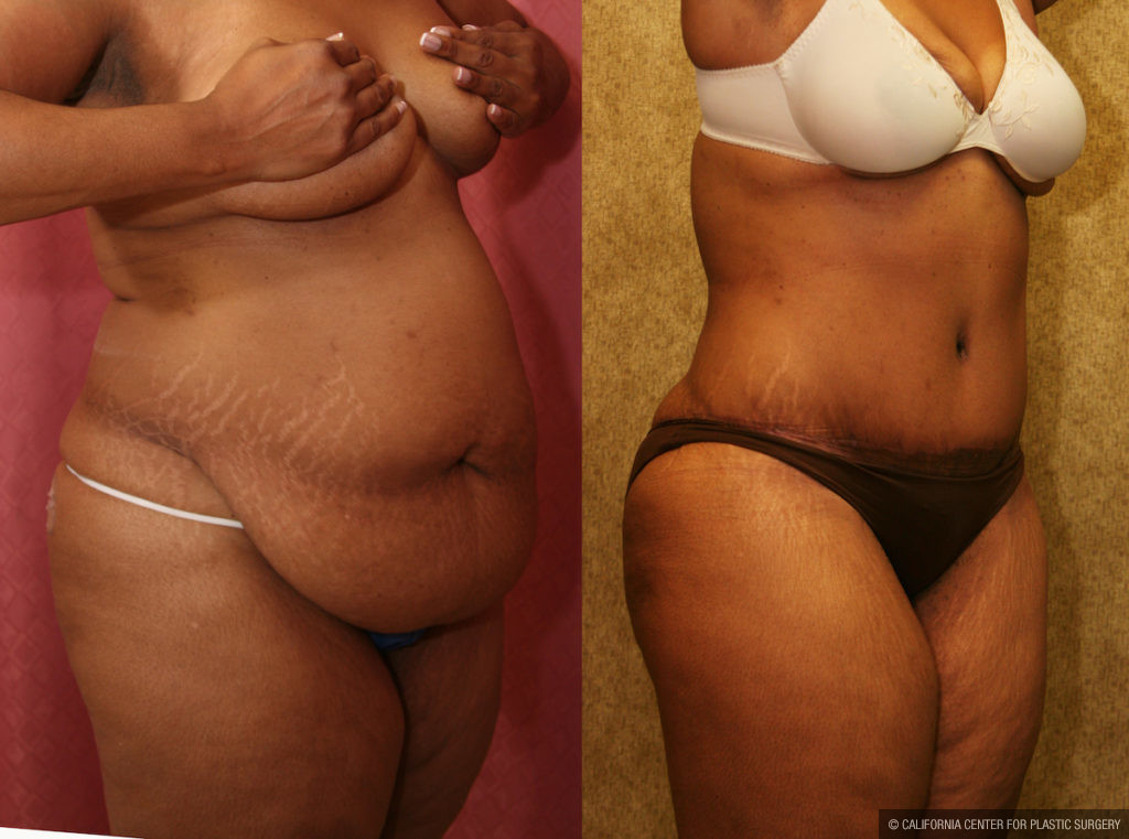 Tummy Tuck (Abdominoplasty) Plus Size Before & After Patient #11551