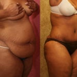 Tummy Tuck (Abdominoplasty) Plus Size Before & After Patient #11551