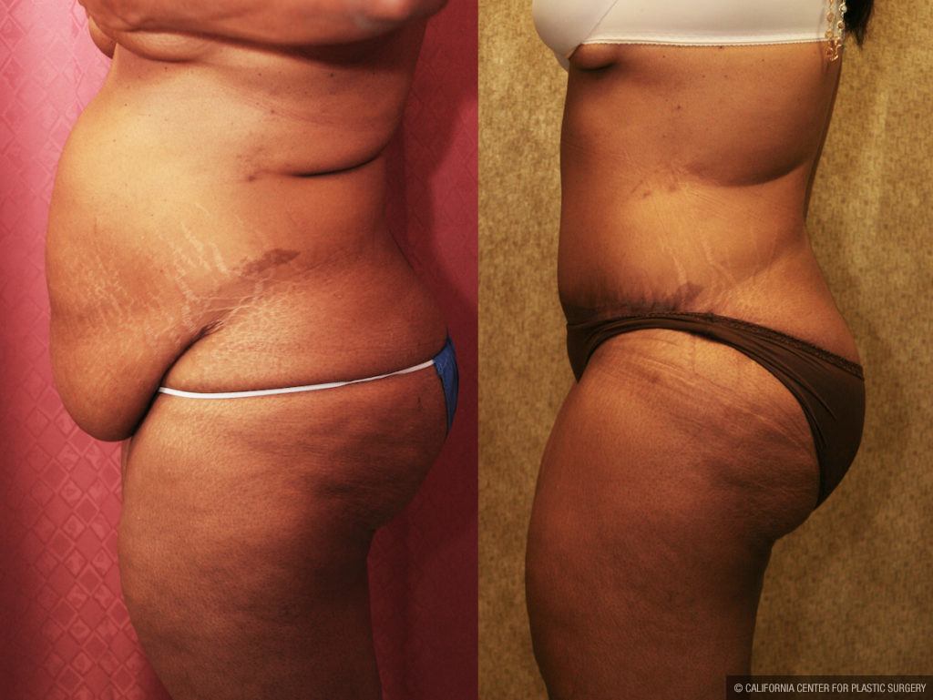 Tummy Tuck (Abdominoplasty) Plus Size Before & After Patient #11551