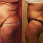 Tummy Tuck (Abdominoplasty) Plus Size Before & After Patient #11551