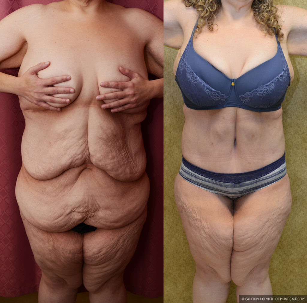 Tummy Tuck (Abdominoplasty) Plus Size Before & After Patient #11557