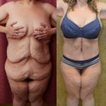 Tummy Tuck (Abdominoplasty) Plus Size Before & After Patient #11557