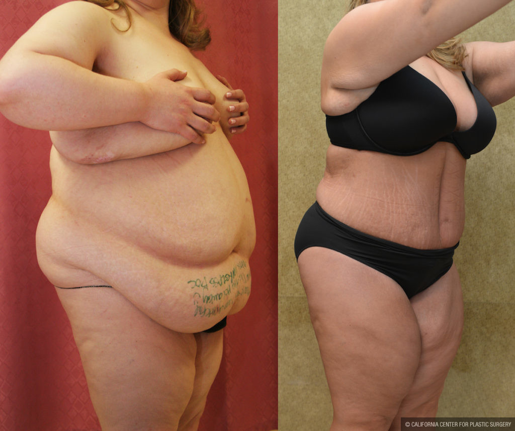 Tummy Tuck (Abdominoplasty) Plus Size Before & After Patient #11561