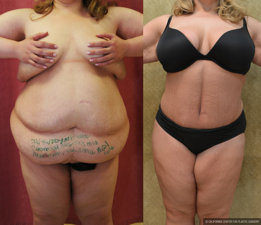 Oregon Plastic Surgeons  Having a Tummy Tuck After Weight Loss