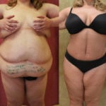 Tummy Tuck (Abdominoplasty) Plus Size Before & After Patient #11561