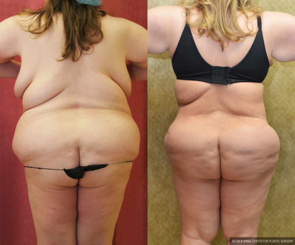 Tummy Tuck (Abdominoplasty) Plus Size Before & After Patient #11561