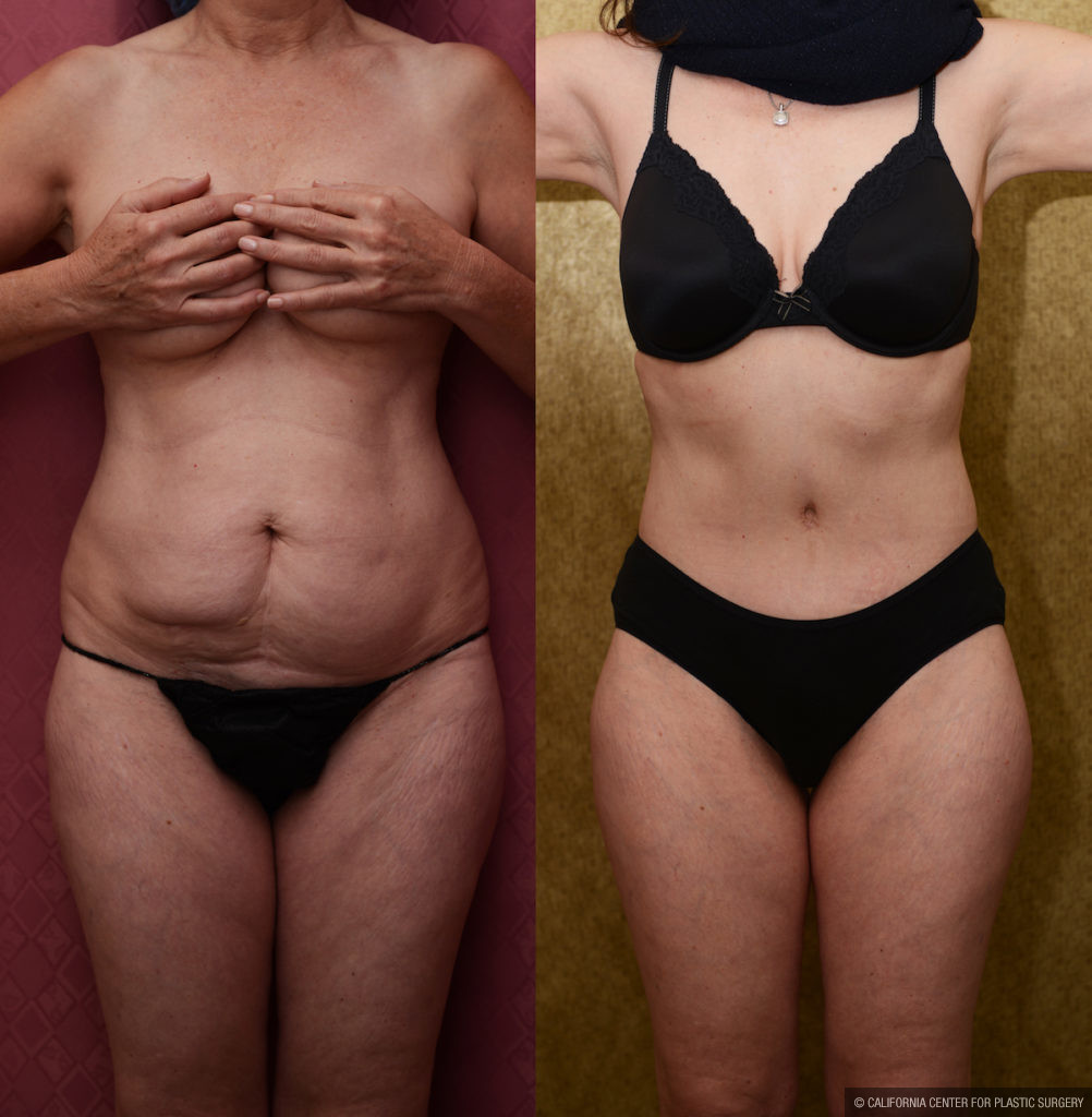 Tummy Tuck Small Size Before & After Patient #11574
