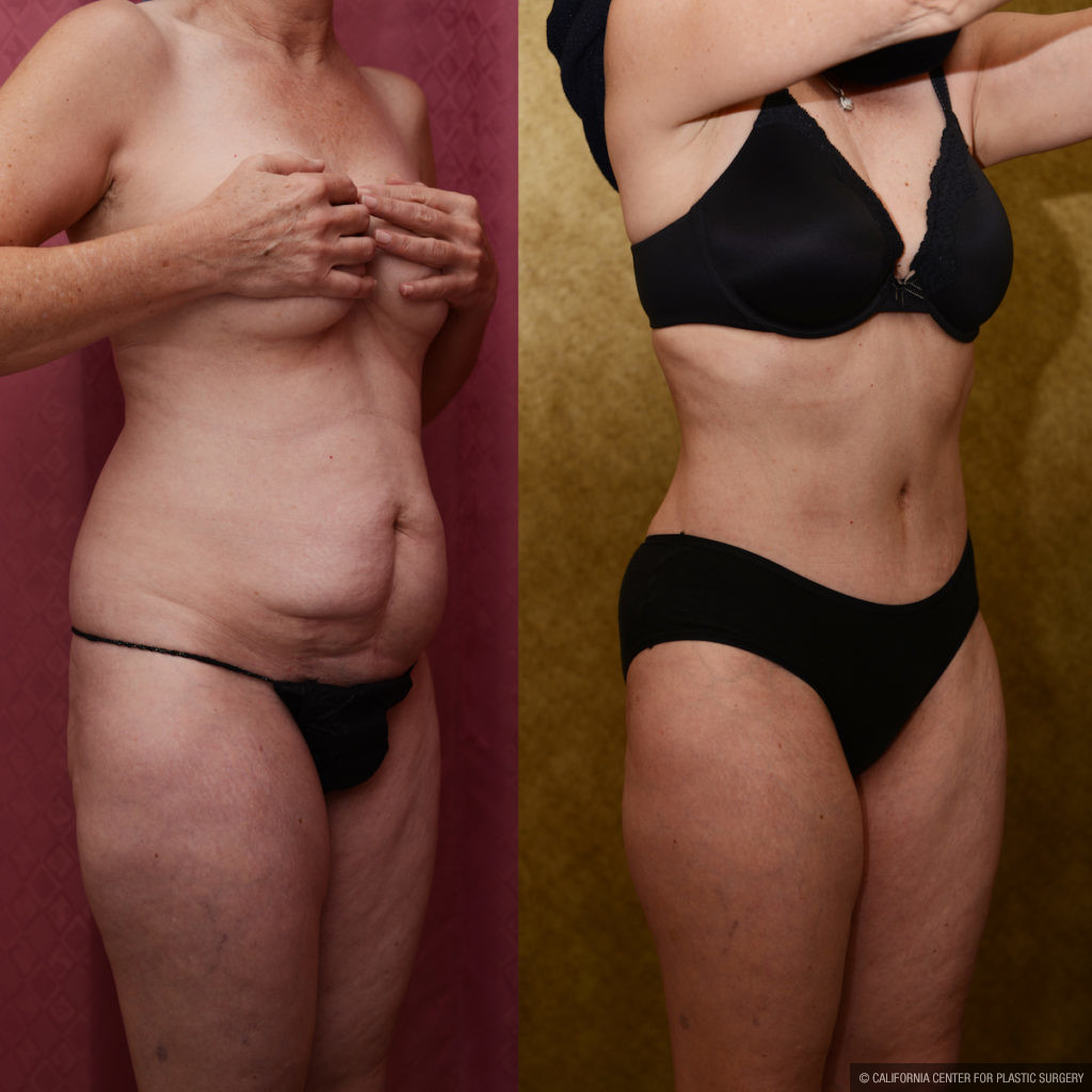 Tummy Tuck Small Size Before & After Patient #11574
