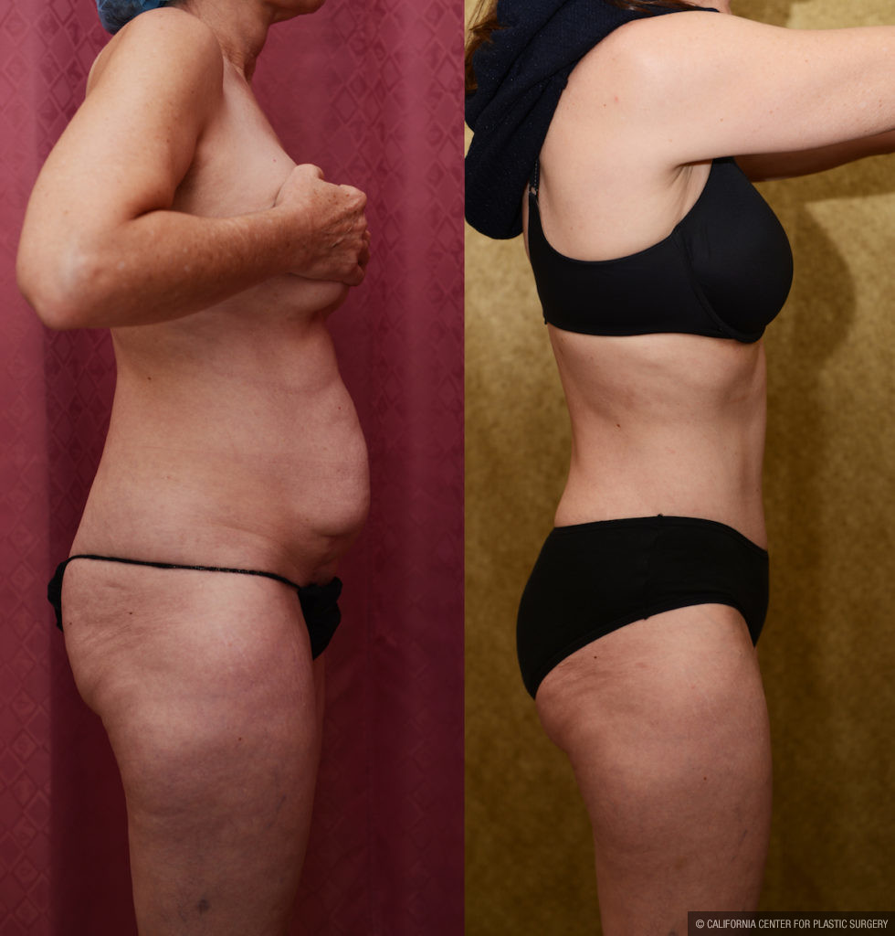 Tummy Tuck Small Size Before & After Patient #11574