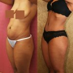 Tummy Tuck (Abdominoplasty) Small Size Before & After Patient #11566