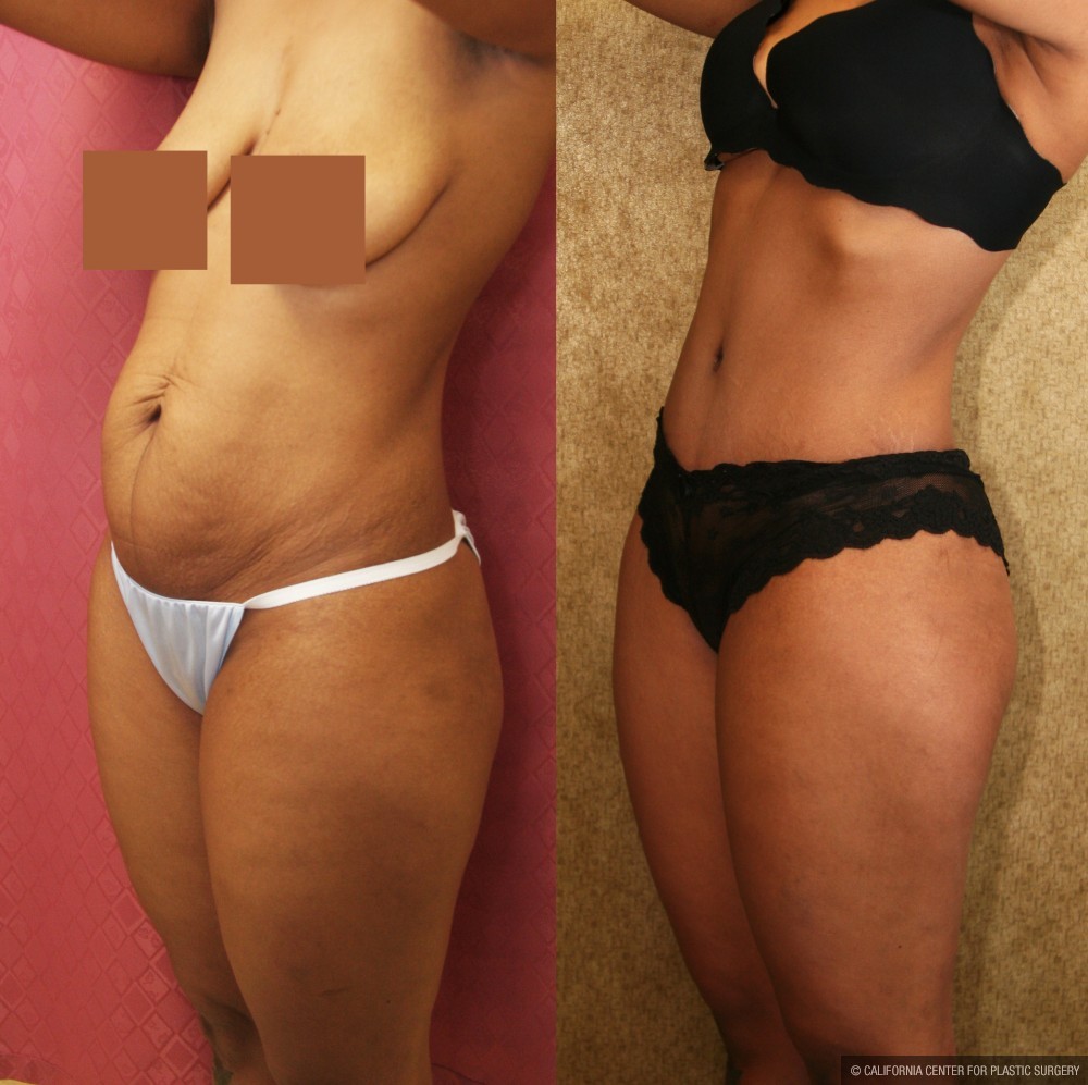 Tummy Tuck (Abdominoplasty) Small Size Before & After Patient #11566