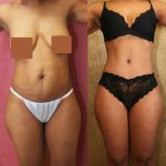 Tummy Tuck (Abdominoplasty) Small Size Before & After Patient #11566