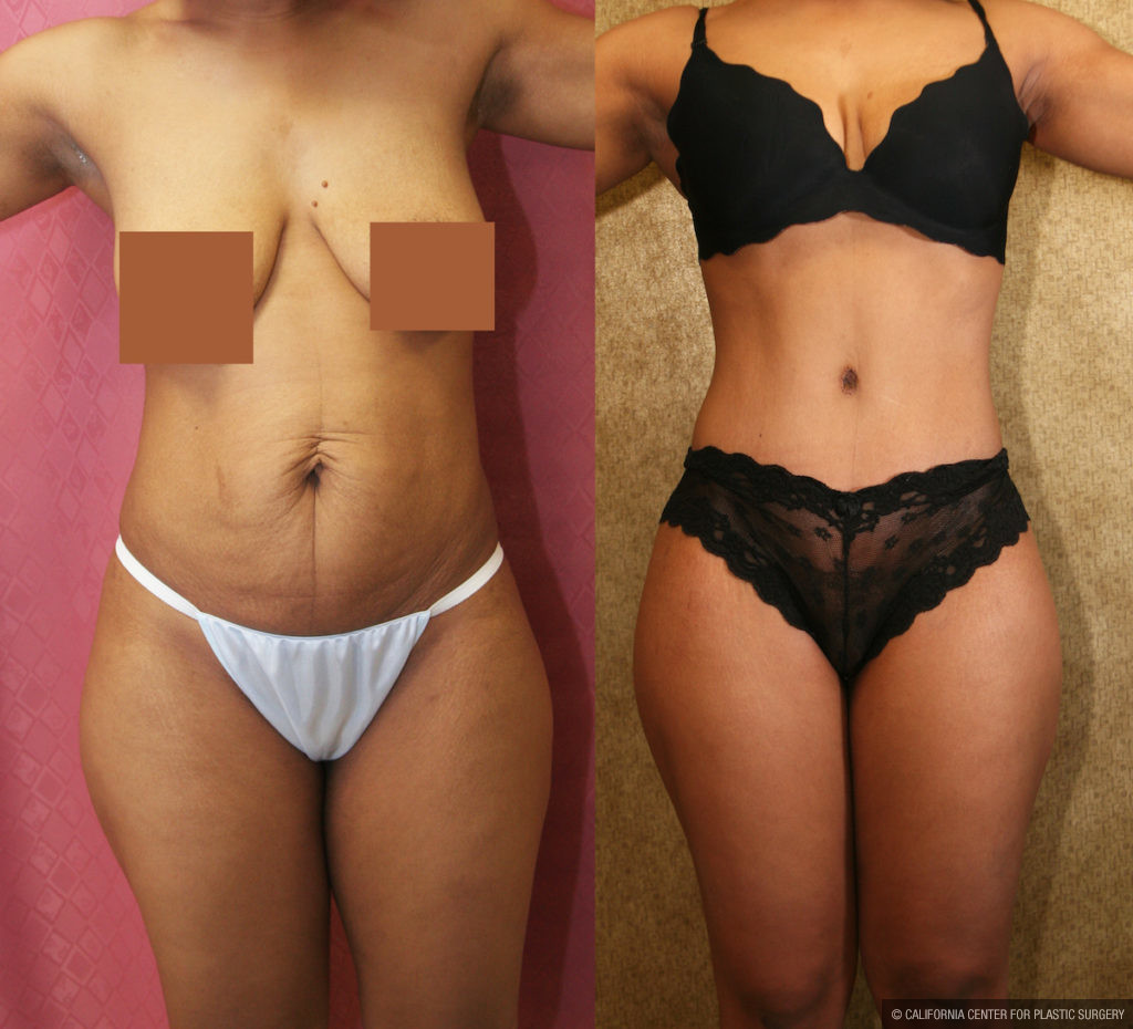 Tummy Tuck Small Size Before & After Patient #11566