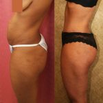 Tummy Tuck (Abdominoplasty) Small Size Before & After Patient #11566