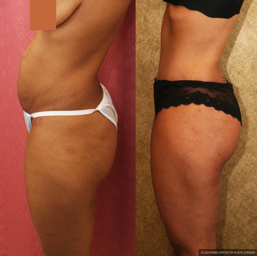 Tummy Tuck (Abdominoplasty) Small Size Before & After Patient #11566