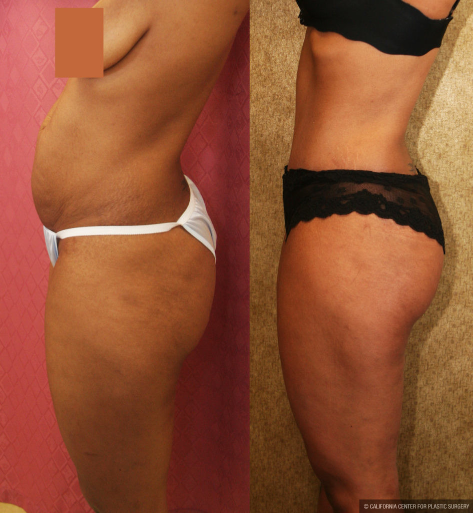 Tummy Tuck Small Size Before & After Patient #11566