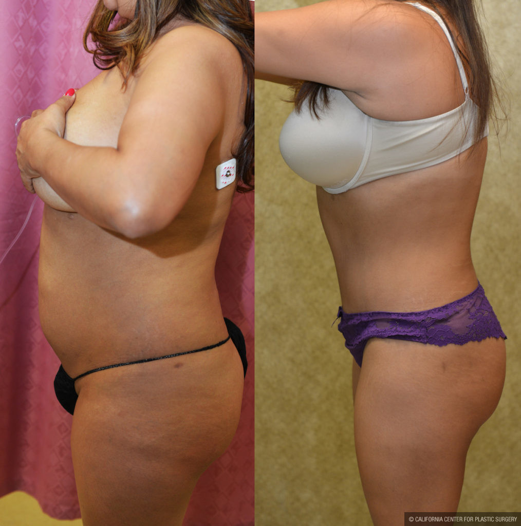 Mini Tummy Tuck Before and After Photo Gallery, Los Angeles, CA