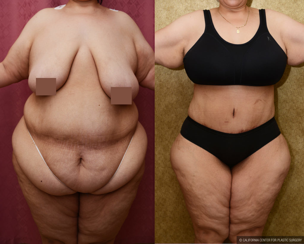 Tummy Tuck (Abdominoplasty) Plus Size Before & After Patient #11543