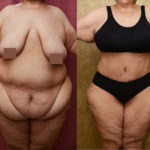 Tummy Tuck (Abdominoplasty) Plus Size Before & After Patient #11543