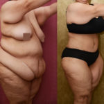 Tummy Tuck (Abdominoplasty) Plus Size Before & After Patient #11543