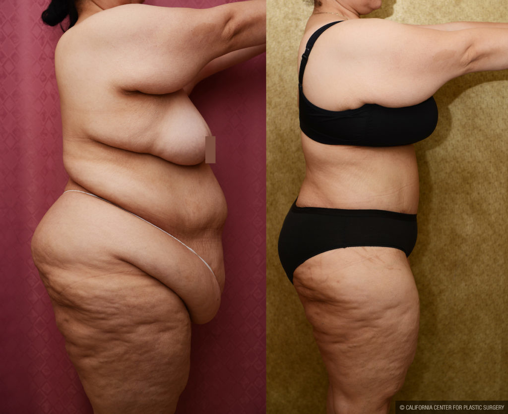 Tummy Tuck (Abdominoplasty) Plus Size Before & After Patient #11543