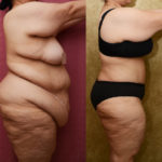 Tummy Tuck (Abdominoplasty) Plus Size Before & After Patient #11543
