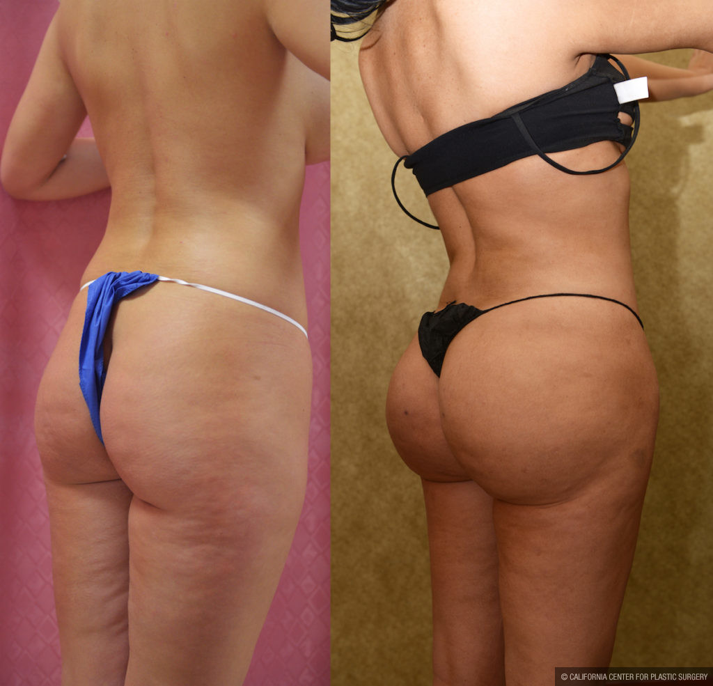 Buttock Lift/Augmentation Before & After Patient #11439