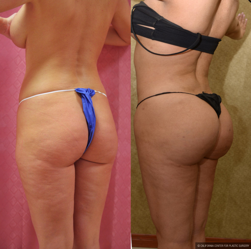 Buttock Lift/Augmentation Before & After Patient #11439