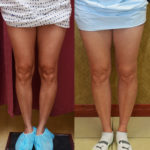 Calf Augmentation Before & After Patient #11444