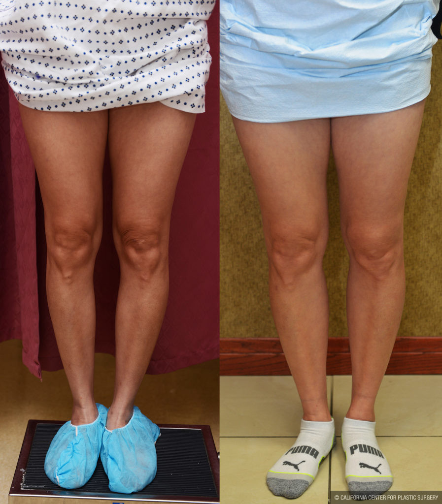 Calf Augmentation Before & After Patient #11444