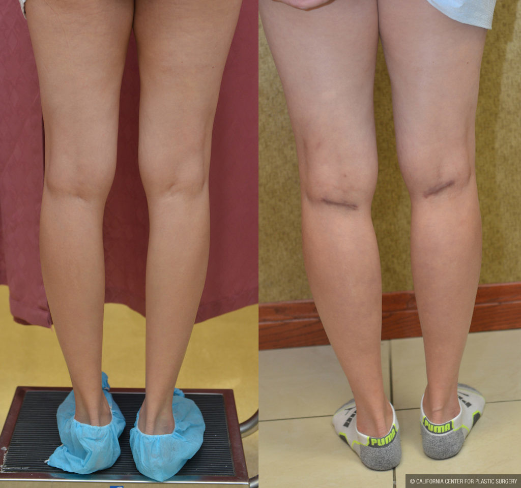 Calf Augmentation Before & After Patient #11444