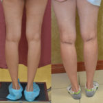 Calf Augmentation Before & After Patient #11444
