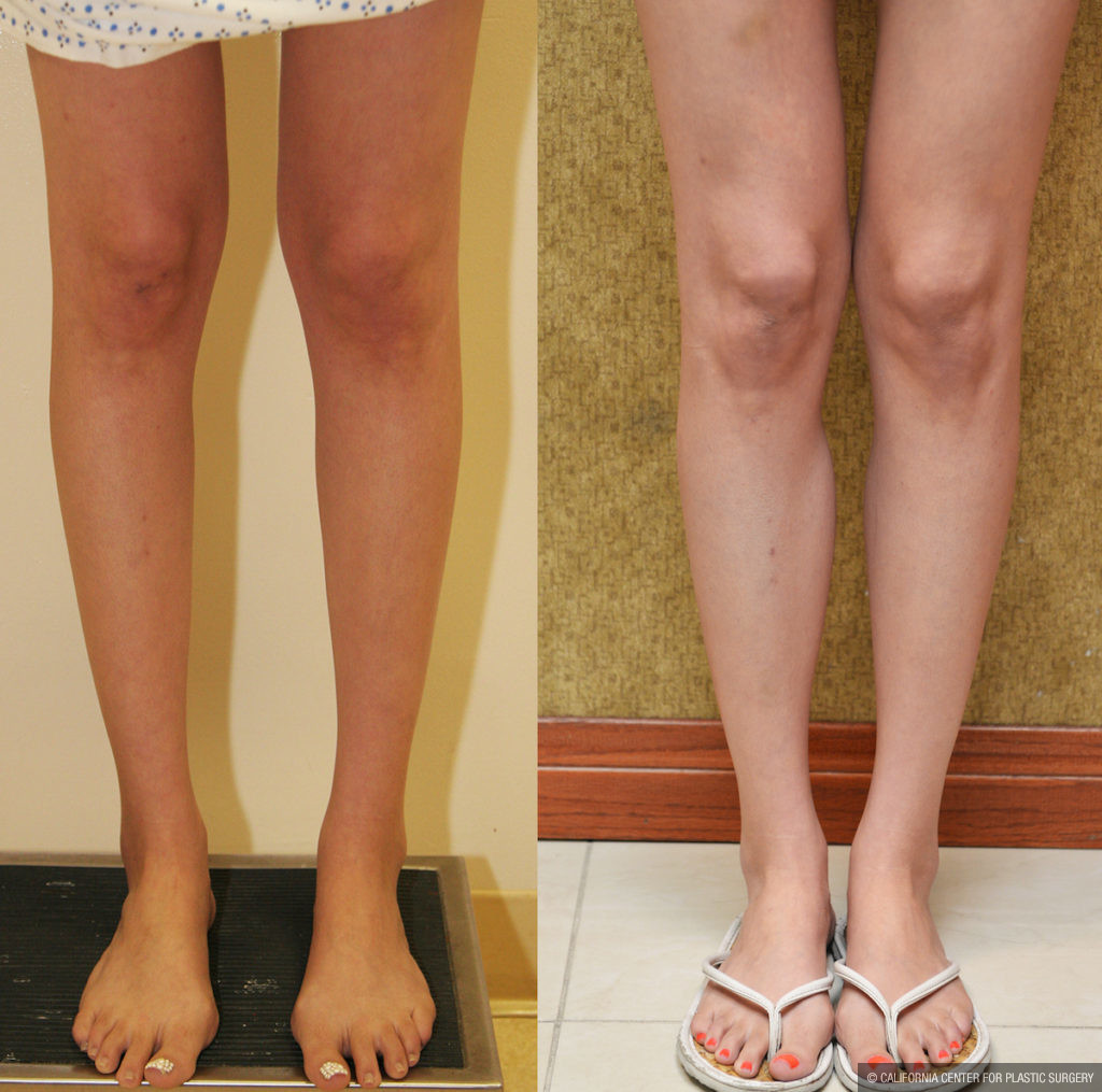 Calf Augmentation Before & After Patient #11448