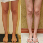 Calf Augmentation Before & After Patient #11448