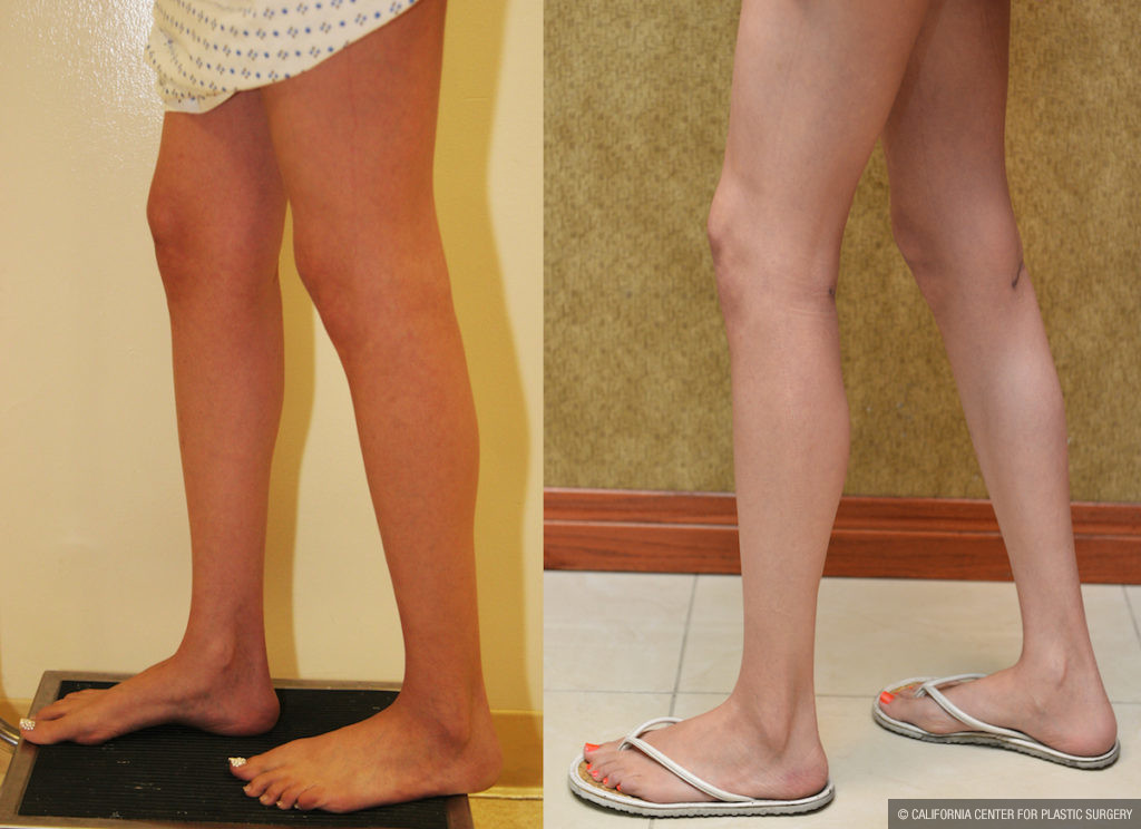 Calf Augmentation Before & After Patient #11448