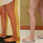 Calf Augmentation Before & After Patient #11448