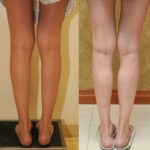 Calf Augmentation Before & After Patient #11448