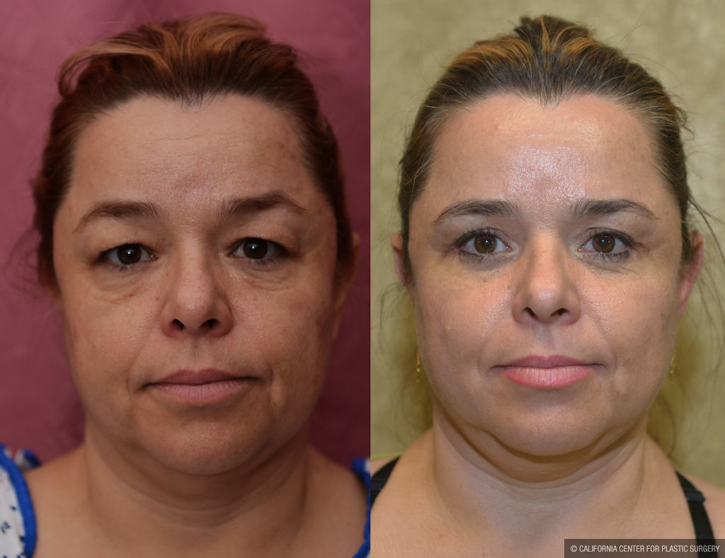 Eyelid (Blepharoplasty) Before & After Patient #11452