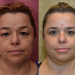 Eyelid (Blepharoplasty) Before & After Patient #11452