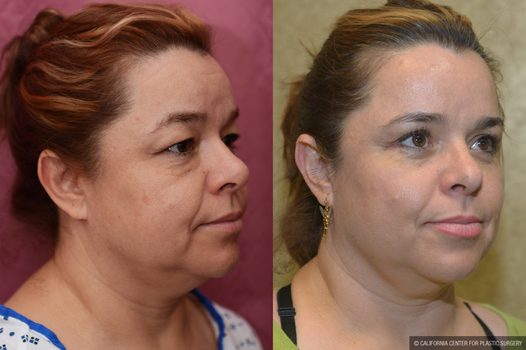 Eyelid (Blepharoplasty) Before & After Patient #11452