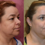 Eyelid (Blepharoplasty) Before & After Patient #11452