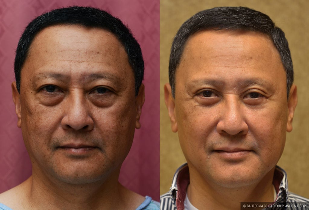 Asian Eyelid Surgery (Blepharoplasty) Before & After Patient #11456